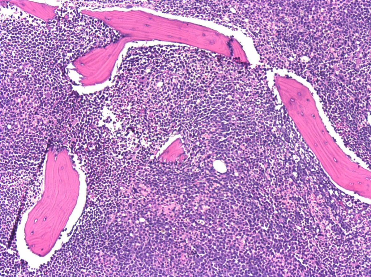 Bone marrow biopsy shows packed cellularity and increased blasts